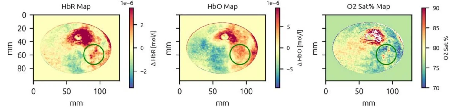 Mapas de HbR, HbO y saturación de oxígeno del Caso 1 (carcinoma ductal invasivo), con la lesión marcada en un círculo verde