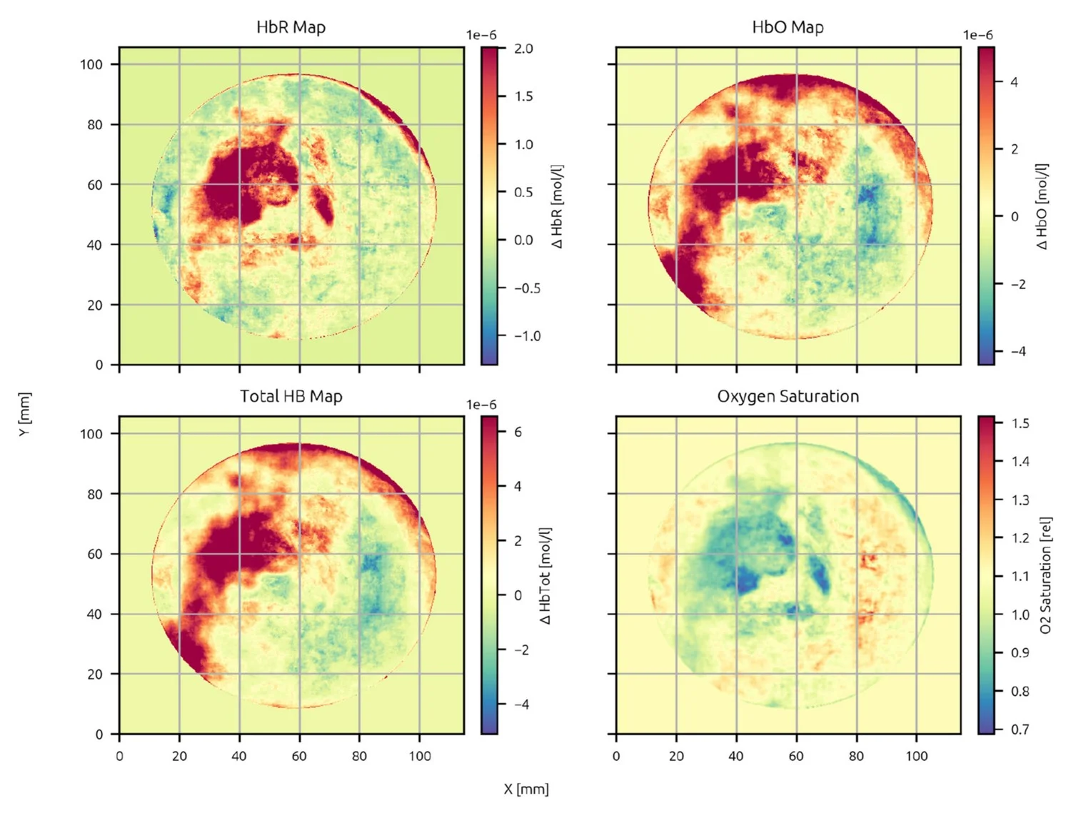 Mapas de HbR, HbO, hemoglobina total y saturación de oxígeno del paciente 8, con carcinoma ductal invasivo confirmado por biopsia
